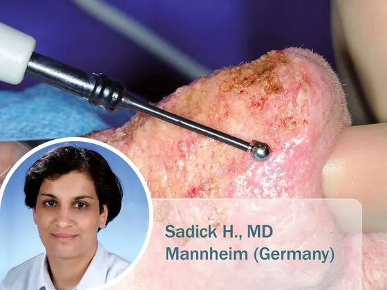 Medizinische Nahaufnahme eines Rhinophyms während einer Behandlung mit einer Kugel-Elektrode; im Bild eingeblendet: Dr. Sudeshna A., Fachärztin für plastische und ästhetische Chirurgie.
