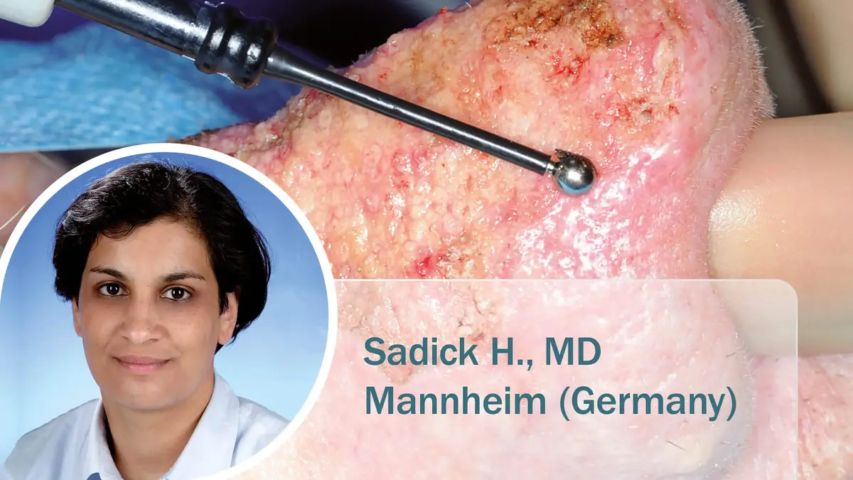 Medizinische Nahaufnahme eines Rhinophyms während einer Behandlung mit einer Kugel-Elektrode; im Bild eingeblendet: Dr. Sudeshna A., Fachärztin für plastische und ästhetische Chirurgie.