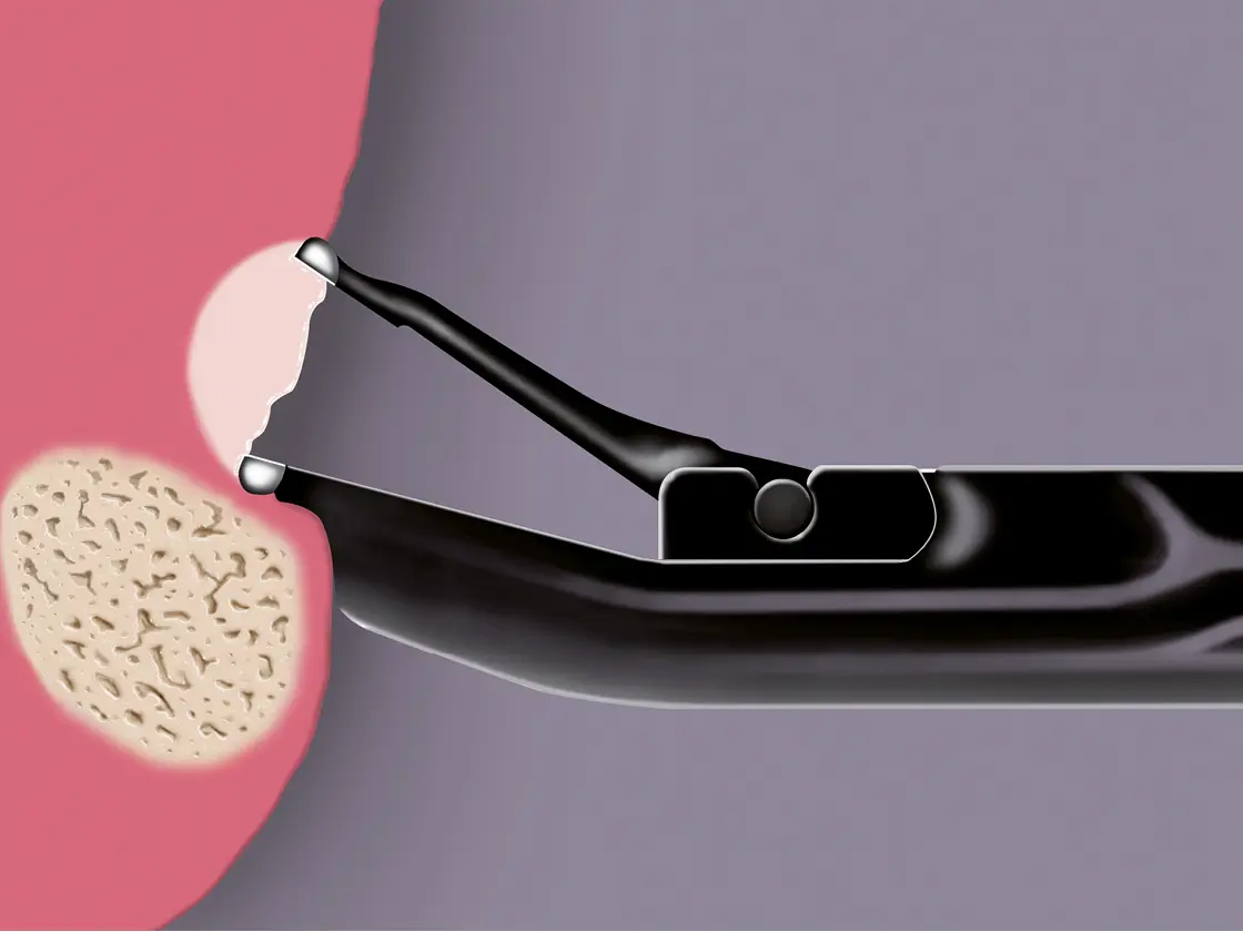 Grafische Darstellung einer Calvian bipolaren Zange bei der Präparation von Gewebe.