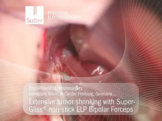 Intraoperatives Bild einer neurochirurgischen Tumorverkleinerung mit bipolarer SuperGliss® non-stick ELP Pinzette; sichtbare Gefäß- und Tumorstrukturen im Operationsfeld.