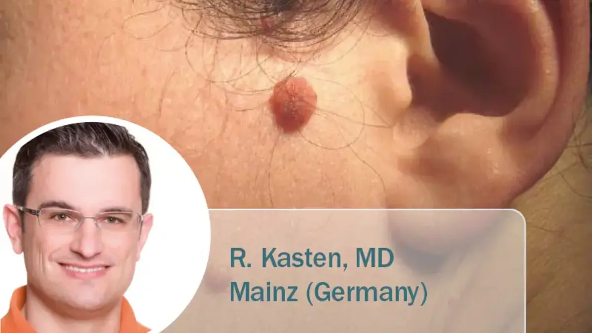 Nahaufnahme eines pigmentierten Muttermals (Naevus) an der Wange eines Patienten nahe dem Ohr; eingeblendet ein Portrait von Dr. Kasten mit dem Hinweis „Mainz | Germany“.