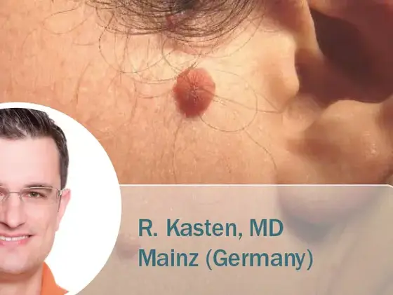 Nahaufnahme eines pigmentierten Muttermals (Naevus) an der Wange eines Patienten nahe dem Ohr; eingeblendet ein Portrait von Dr. Kasten mit dem Hinweis „Mainz | Germany“.