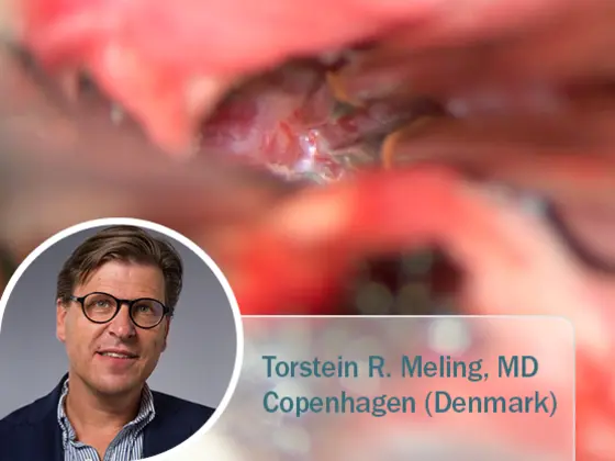 Chirurgische Nahaufnahme einer Oberlidkorrektur mit Radiofrequenz-Technologie; eingeblendet ist Dr. Thomas Mahler, Facharzt für Dermatologie aus Deutschland.